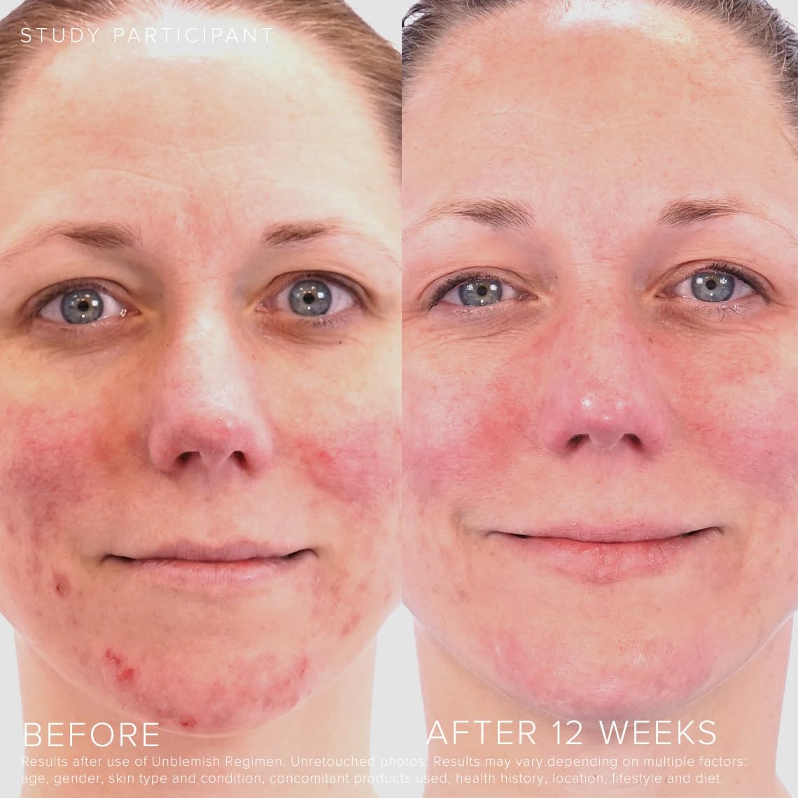 Rodan + Fields Unblemish Dual Intensive Acne Treatment | 0.76 Fl Oz | Targets Blemishes | Benzoyl Peroxide & Ceramides - Image 3