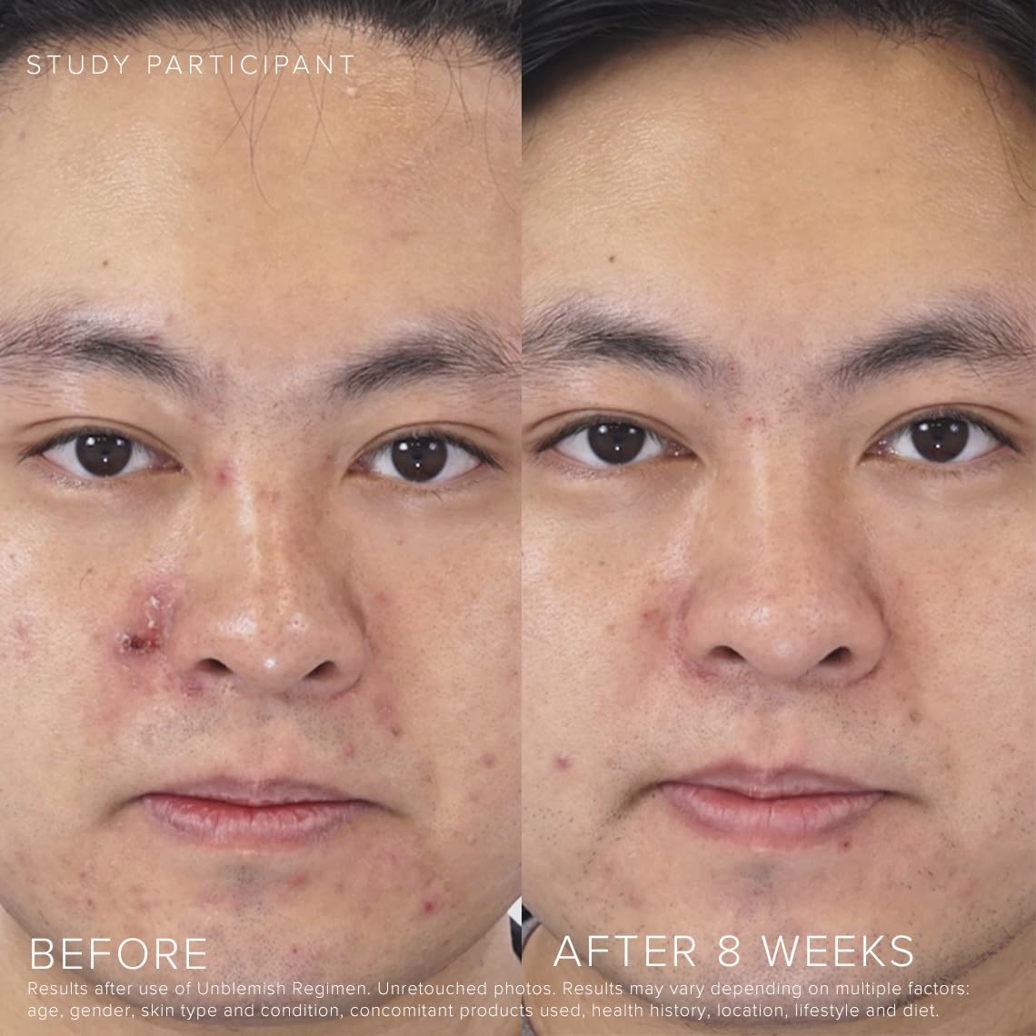 Rodan + Fields Unblemish Dual Intensive Acne Treatment | 0.76 Fl Oz | Targets Blemishes | Benzoyl Peroxide & Ceramides - Image 4