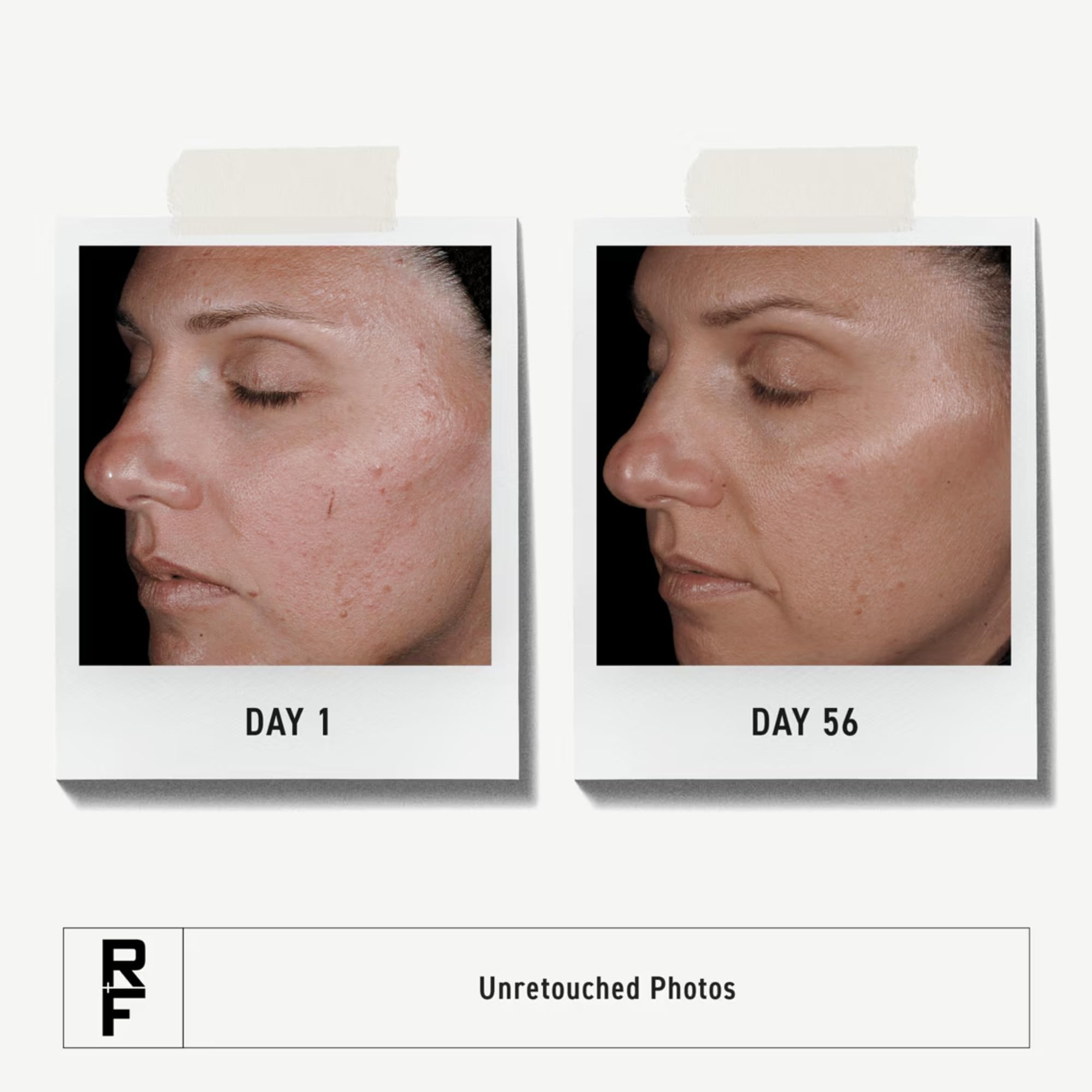 Rodan + Fields UNBLEMISH Skin Care Regimen | Skincare Set For Adult Acne | Cleanser Face Wash, Toner, Dual Acne Treatment & SPF 30 Sunscreen - Image 2